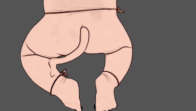 তিন মাসের শিশুর লেজ বিরল অস্ত্রোপচারে সফল অপসারন 